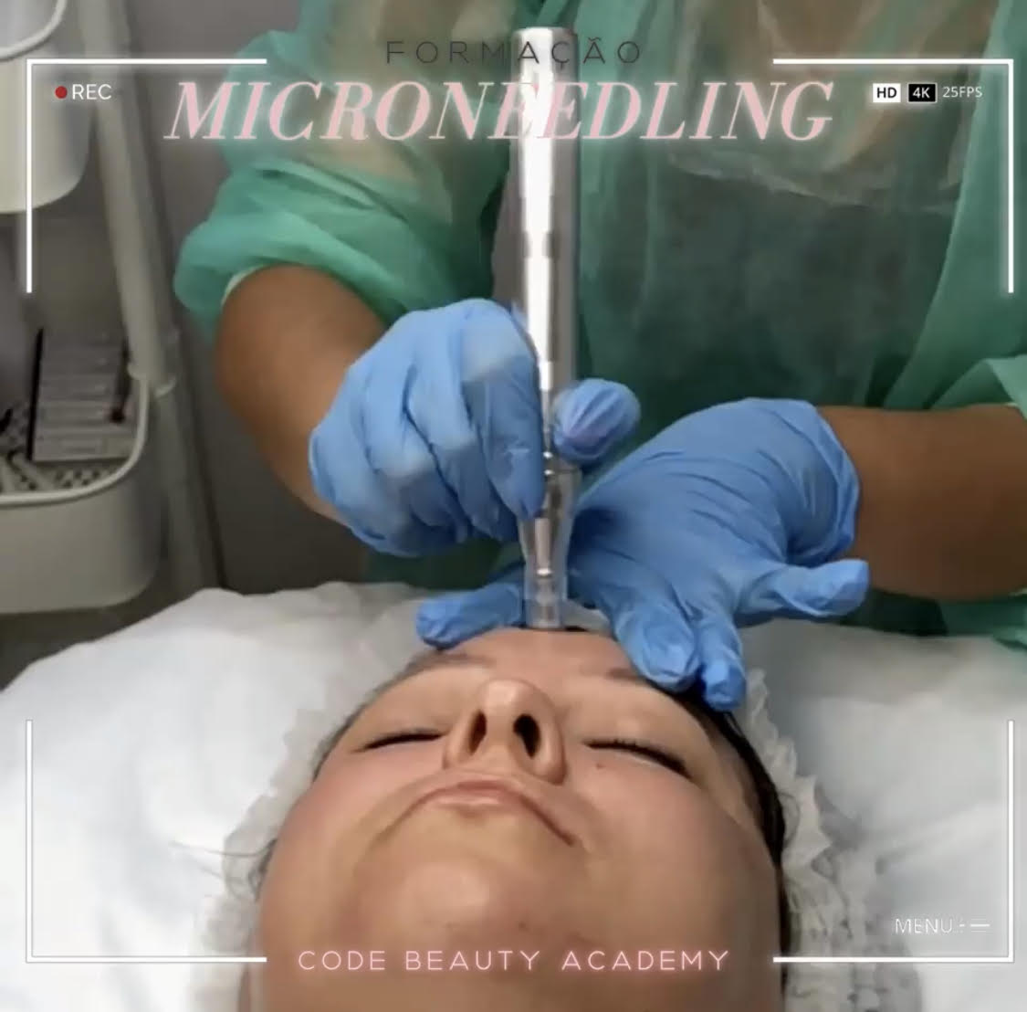 MicroNeedling