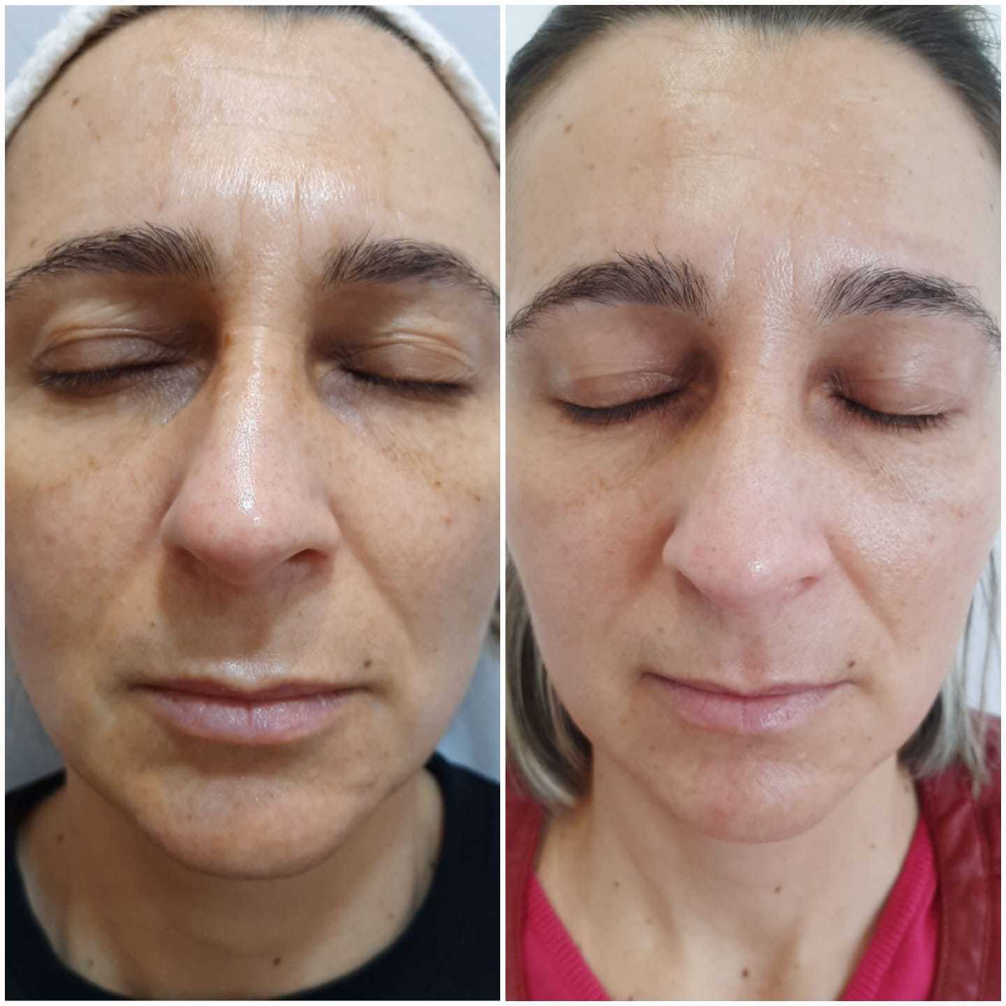 Blefaroplastia sem corte - Carla Leiria